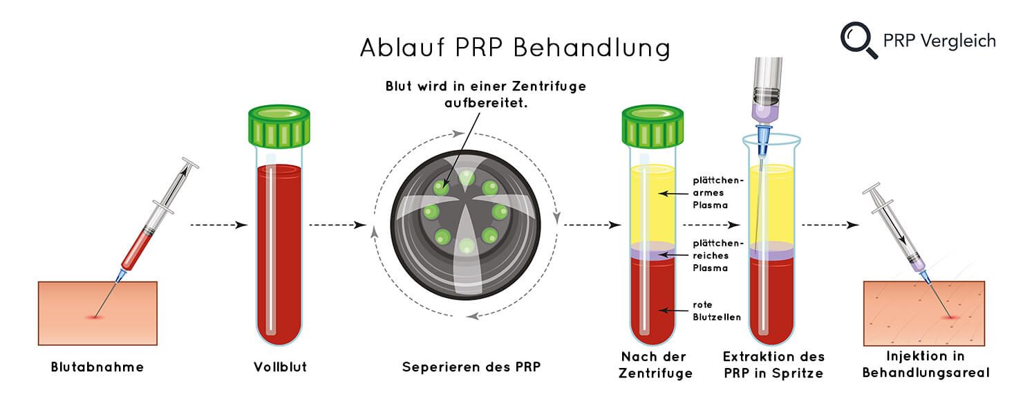 Schaubild Ablauf einer PRP-Behandlung